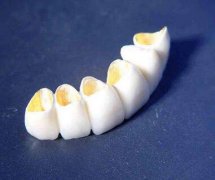 非贵金属烤瓷牙好不好？来听听这位牙科专家是咋个给你解释的！ width=