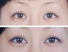 开眼角术前注意什么？ width=