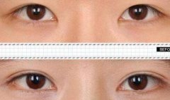 双眼皮做失败怎么修复？ width=