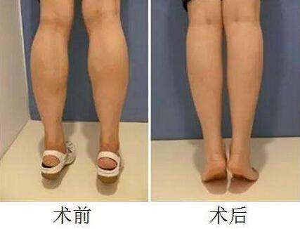 深圳瘦小腿大概多少钱？