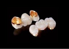 金钯合金烤瓷牙的价格贵吗？ width=