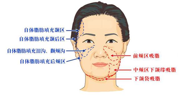 拉皮手术要多少钱