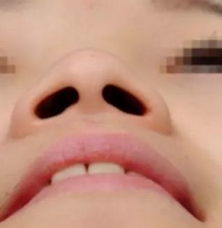 鼻头肥大鼻翼外扩怎么办？|鼻整形大咖李琳教授有话说