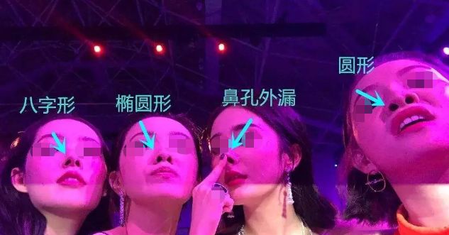 鼻头肥大鼻翼外扩怎么办？|鼻整形大咖李琳教授有话说