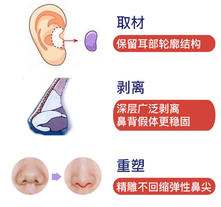 鼻头肥大鼻翼外扩怎么办？|鼻整形大咖李琳教授有话说