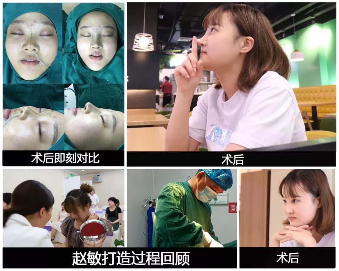 鼻头肥大鼻翼外扩怎么办？|鼻整形大咖李琳教授有话说