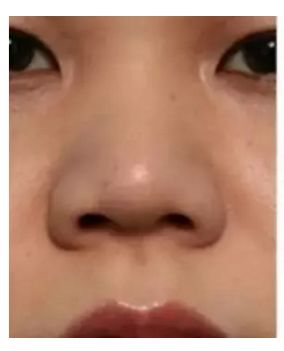 鼻头肥大鼻翼外扩怎么办？|鼻整形大咖李琳教授有话说