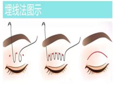 高分子埋线双眼皮多少钱?