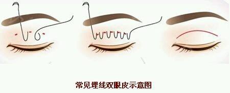 高分子埋线双眼皮多少钱?