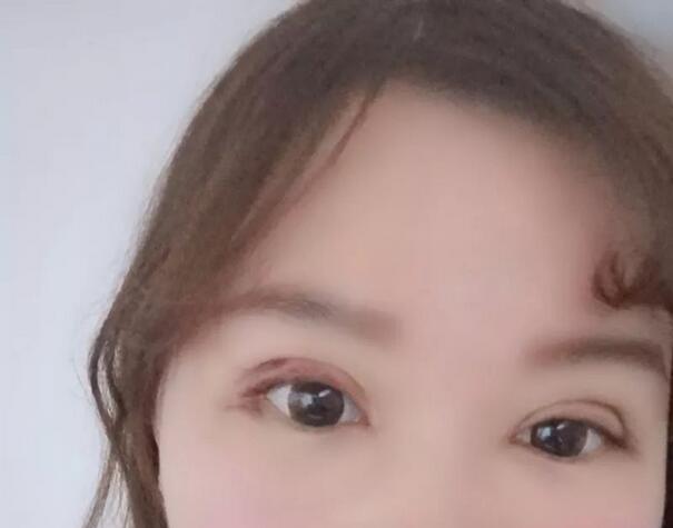 济南悦荟丽格整形说：校园女神，往往只需要一个双眼皮！
