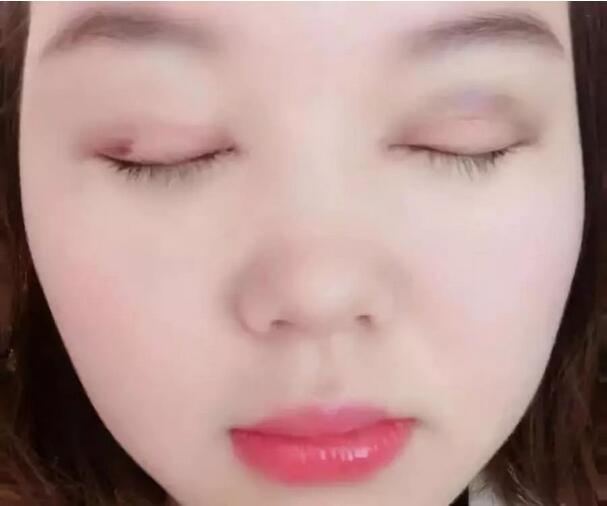 济南悦荟丽格整形说：校园女神，往往只需要一个双眼皮！