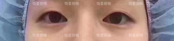 悦荟丽格做媚眼部手术术一个月日记真实分享~