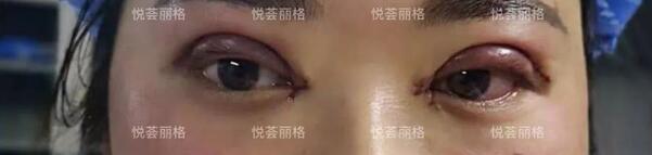 悦荟丽格做媚眼部手术术一个月日记真实分享~