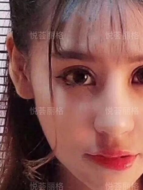 悦荟丽格做媚眼部手术术一个月日记真实分享~