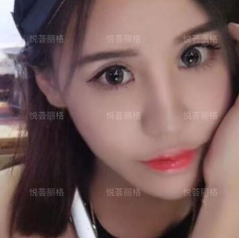 悦荟丽格做媚眼部手术术一个月日记真实分享~