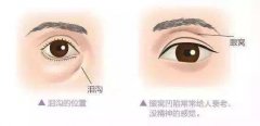 自体脂肪填充眼窝的果是长久的吗? width=