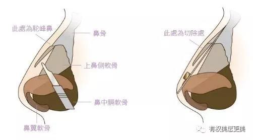 天津驼峰鼻矫正的价钱大概多少?