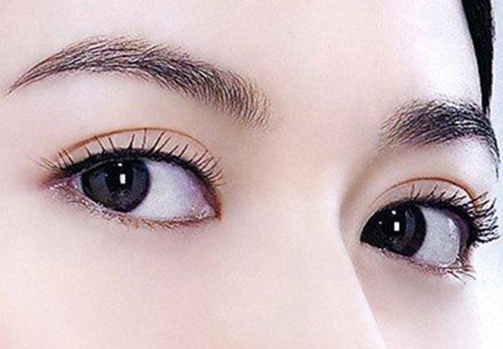 生物焊接双眼皮大概多少钱?