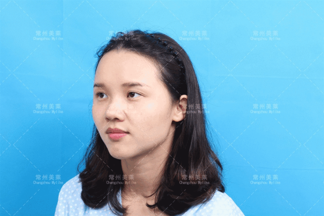 为了填补脸上的凹陷，聪明的人都选择它！
