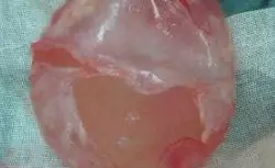 【隆胸后胸部硬如馒头，是包膜挛缩吗？】