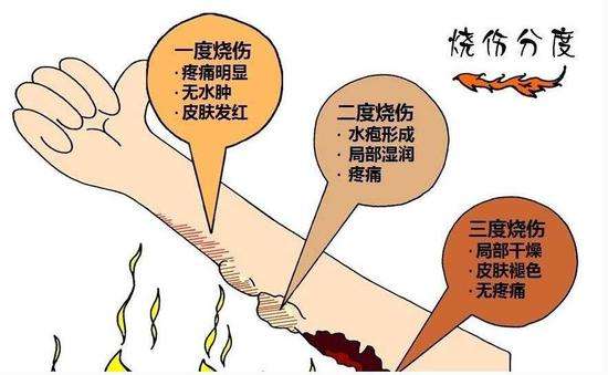 烫伤疤痕修复多少钱?