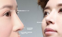 鼻小柱延长的两种手术方法 width=