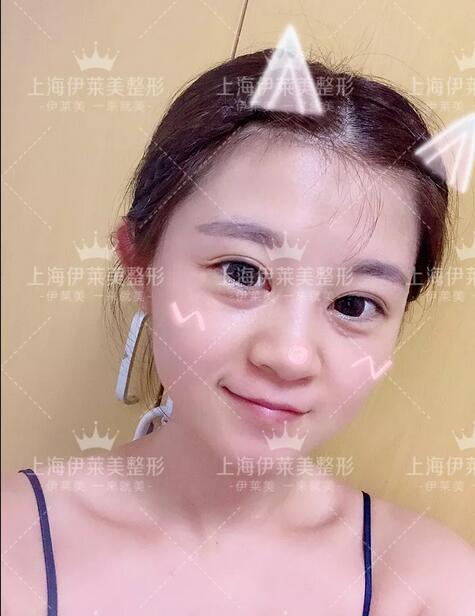 眶隔脂肪释放去眼袋术后两个月恢复日记一则~