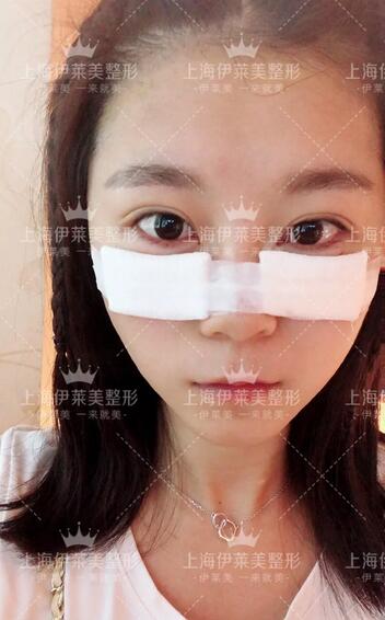 眶隔脂肪释放去眼袋术后两个月恢复日记一则~