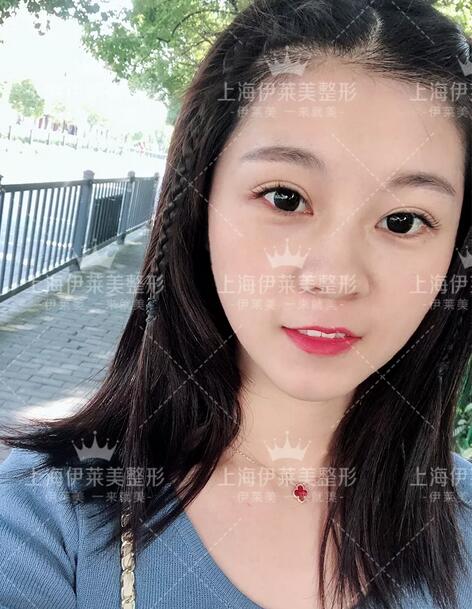 眶隔脂肪释放去眼袋术后两个月恢复日记一则~
