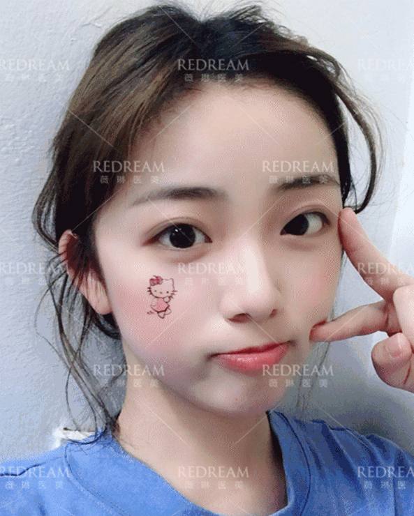 自体脂肪面部填充有哪些优势？我悄悄告诉你~