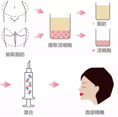 自体脂肪面部填充有哪些优势？我悄悄告诉你~