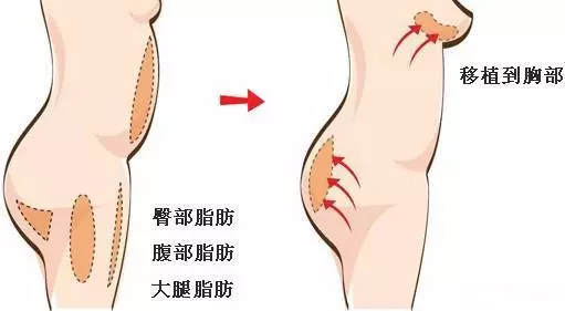 自体脂肪面部填充有哪些优势？我悄悄告诉你~