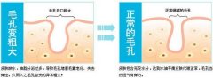 毛孔粗大这么做 再也不用担心毛孔问题啦 width=