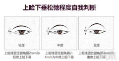 上睑下垂的三种调节方式 width=