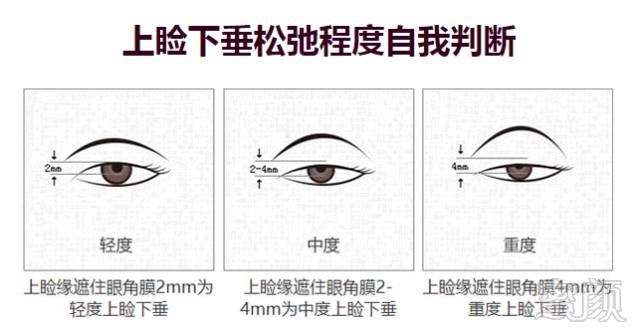 上睑下垂的三种调节方式