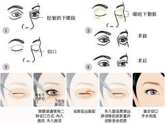 眼部抽脂重获年轻的大眼魅力 width=