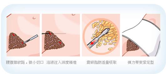 腰腹吸脂帮你甩掉游泳圈