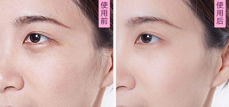 眼角细纹怎么去 方法有哪些