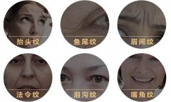 皱纹出现的先后你属于几岁肌肤 width=