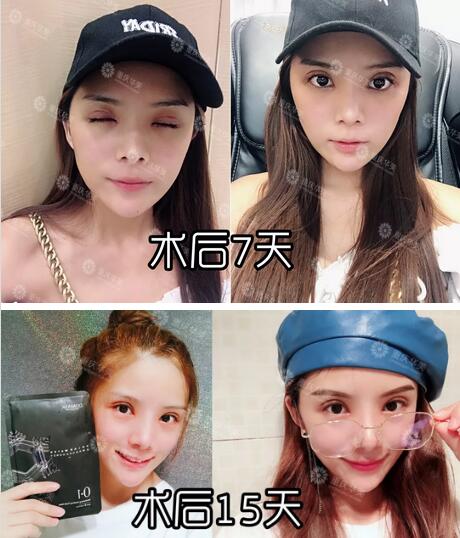 双眼皮培训3天可出师？瞎扯！来看30年经验的医生是怎么割的