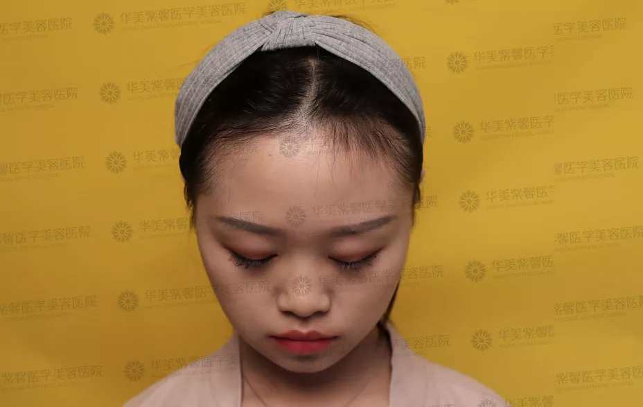 自体脂肪填充苹果肌、额头、下巴、眼窝的优势？谁来说说~