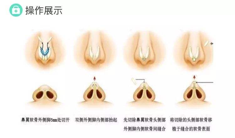 鼻尖延长改良鼻部缺陷使鼻子变得