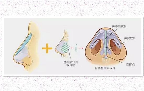 鼻小柱延长三种手术方法改良鼻畸形