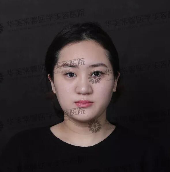 V雕吸脂瘦脸果图，微雕吸脂瘦脸果好吗？