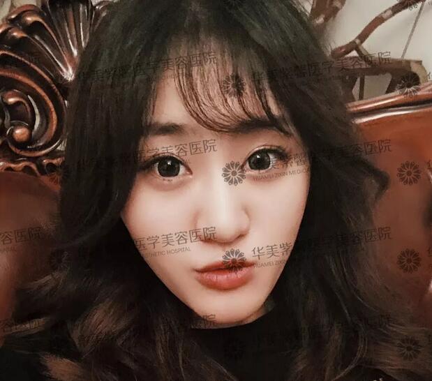 V雕吸脂瘦脸果图，微雕吸脂瘦脸果好吗？
