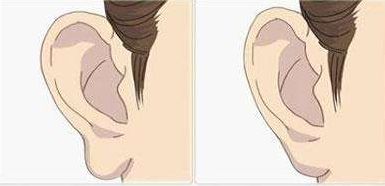 丰耳垂的两种常用手术方法