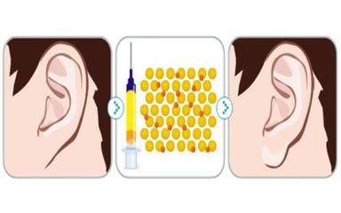 丰耳垂的两种常用手术方法