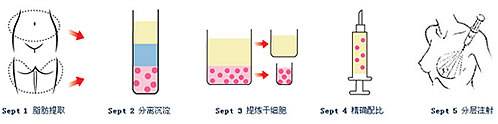 假体隆胸 胸部不聚拢是什么原因
