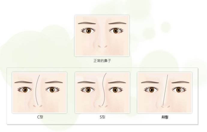 鼻尖延长改良鼻部缺陷使鼻子变得