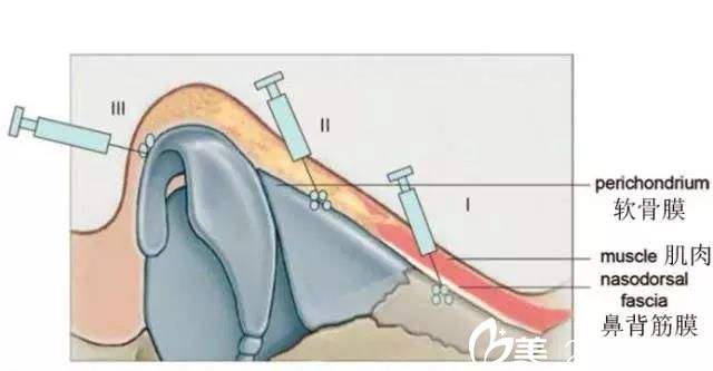 注射隆鼻这几大优势掀起了一股新风